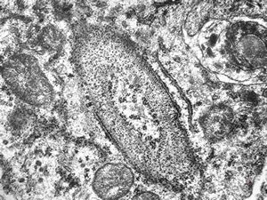 M,41y. | ribosome-lamella complex in tricholeukocyte -hairy cell leukemia, spleen
